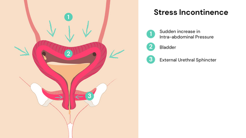 How does stress incontinence happen?