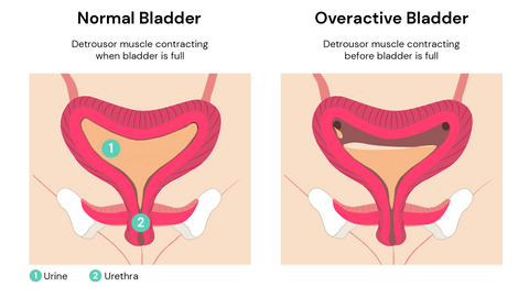 What is an overactive bladder?