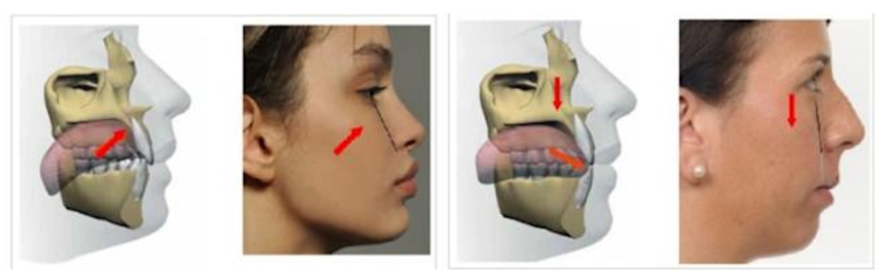 How Mewing Changes Your Face Shape