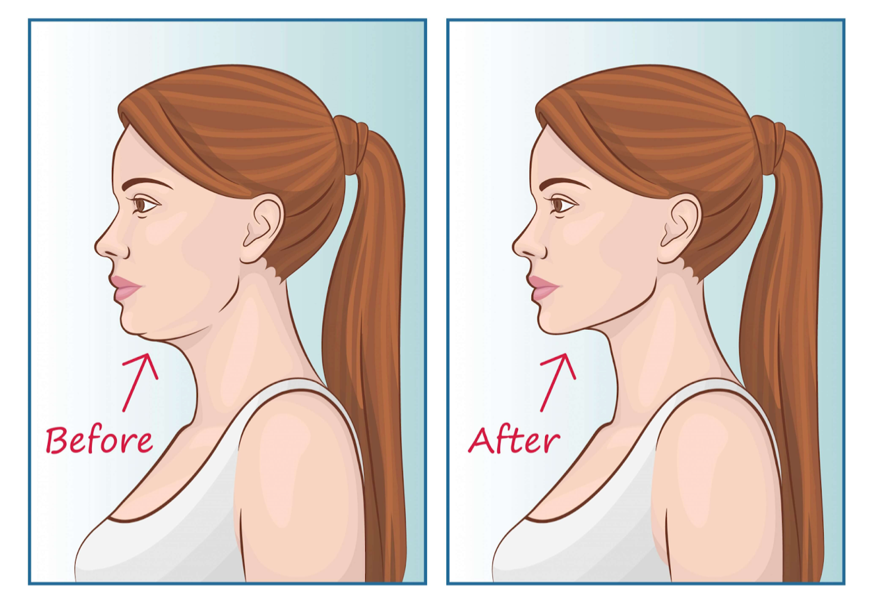 What Is Mewing and How It Can Improve Your Jawline? – ROCKJAW®