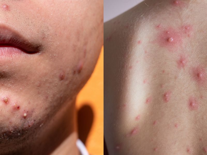 acne affecting the face and back