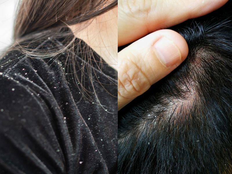 dandruff and flaky skin on scalp