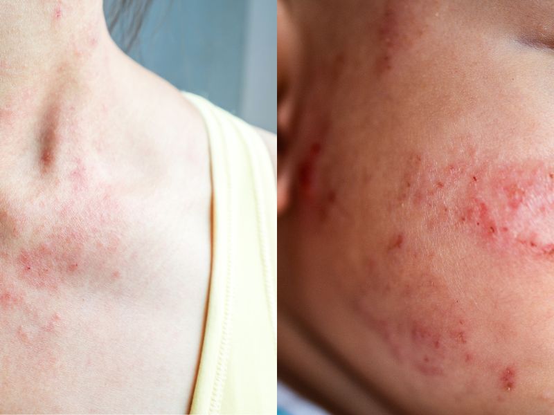 atopic dermatitis/eczema symptoms and treatment