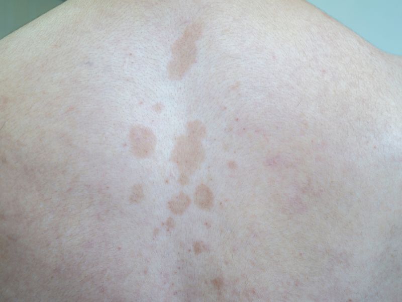 tinea versicolor symptoms