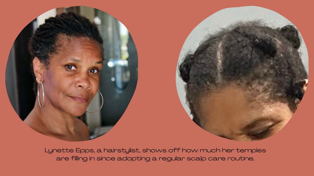 Lynette Epps, a hairstylist, shows off how much her temples are filling in since adopting a regular scalp care routine.