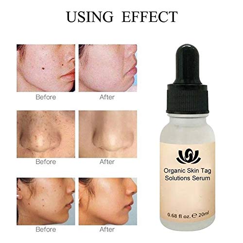 Onkessy Skin Tag Remover Organic Tags Solutions Serum For Fast Removal Moles and Skin Tags Facial Serum for All 20ml