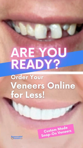A comparison of Snap-On or clip in veneers and traditional veneers, showcasing the pros and cons of each option to help you determine which one is right for you based on your budget, dental goals, and lifestyle preferences.