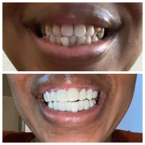 A before-and-after comparison of a person's smile transformed with Snap-On veneers, showcasing their ability to provide a teeth straightening alternative
