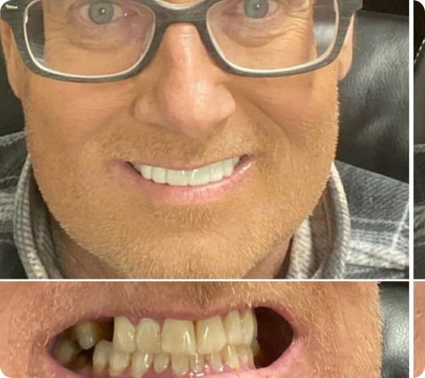 A person smiling confidently with Snap-On veneers, demonstrating how these removable dental veneers can help restore one's confidence and make them feel good about their smile again