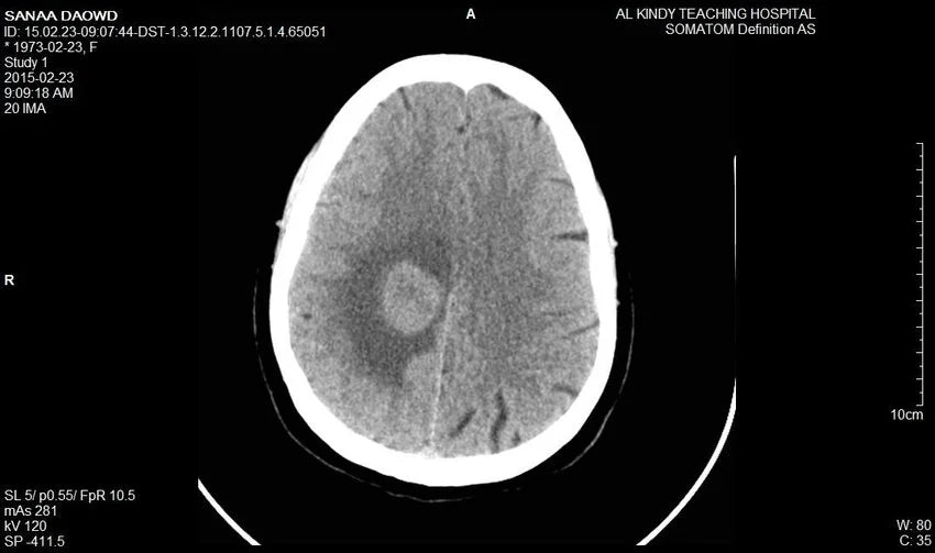 computed tomography of a human brain tumor