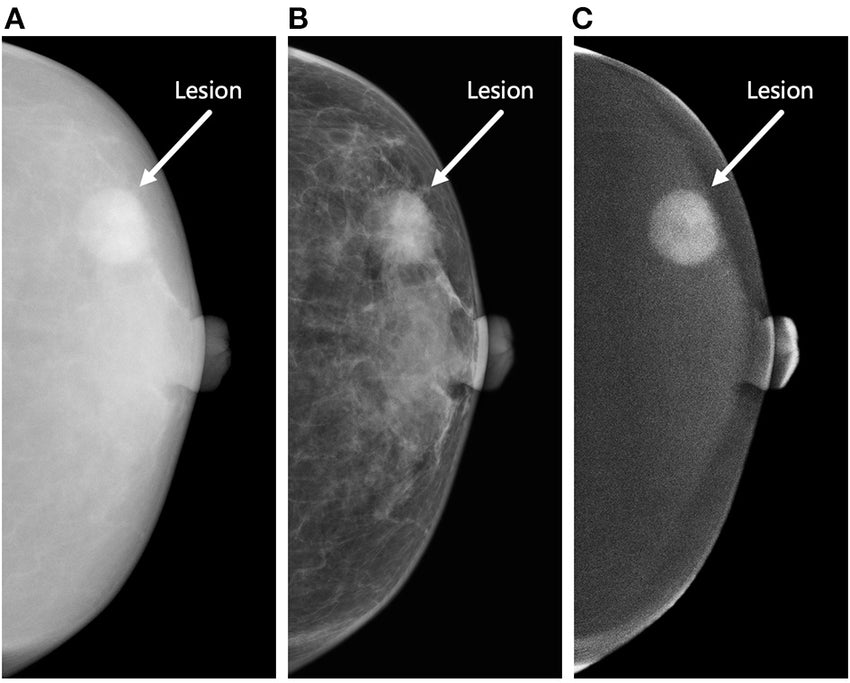 three types of contrast-enhanced mammography CEM