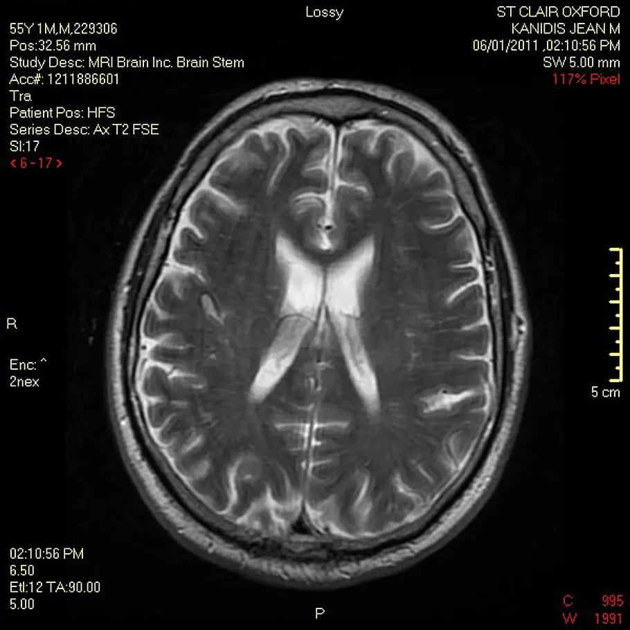 brain MRI scan