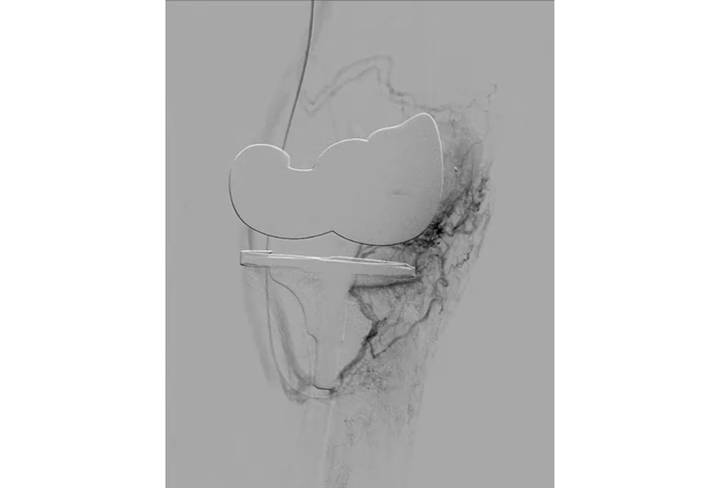 Angiogram of GAE