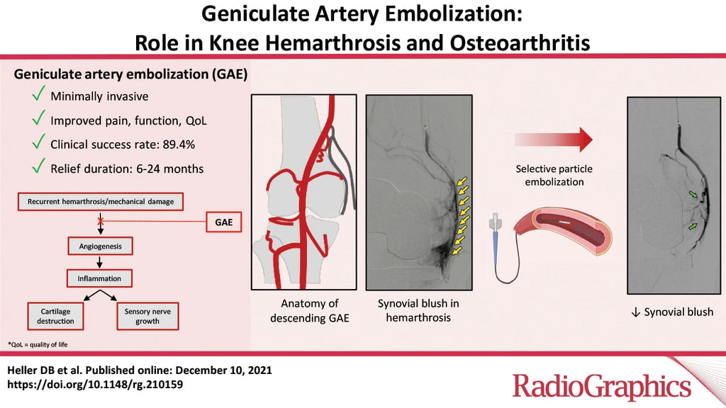 Geniculate Artery Embolization