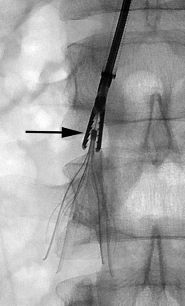 inferior vena cava filter placement