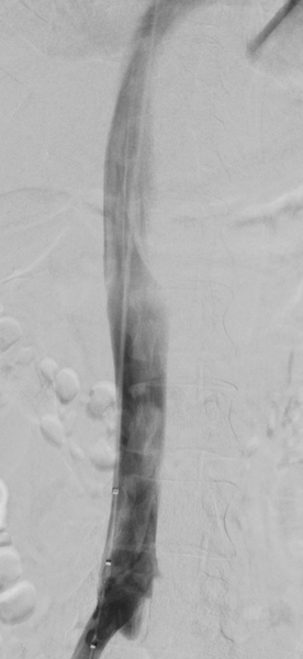 inferior vena cava filter collapsed view