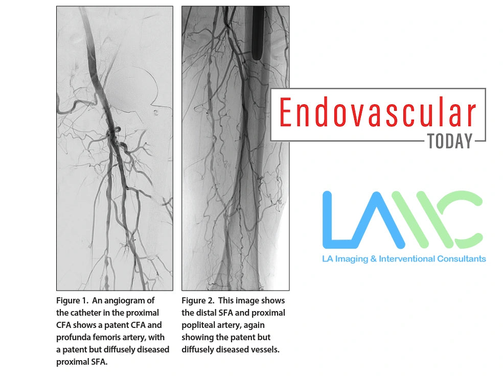 peripheral artery disease endovascular today