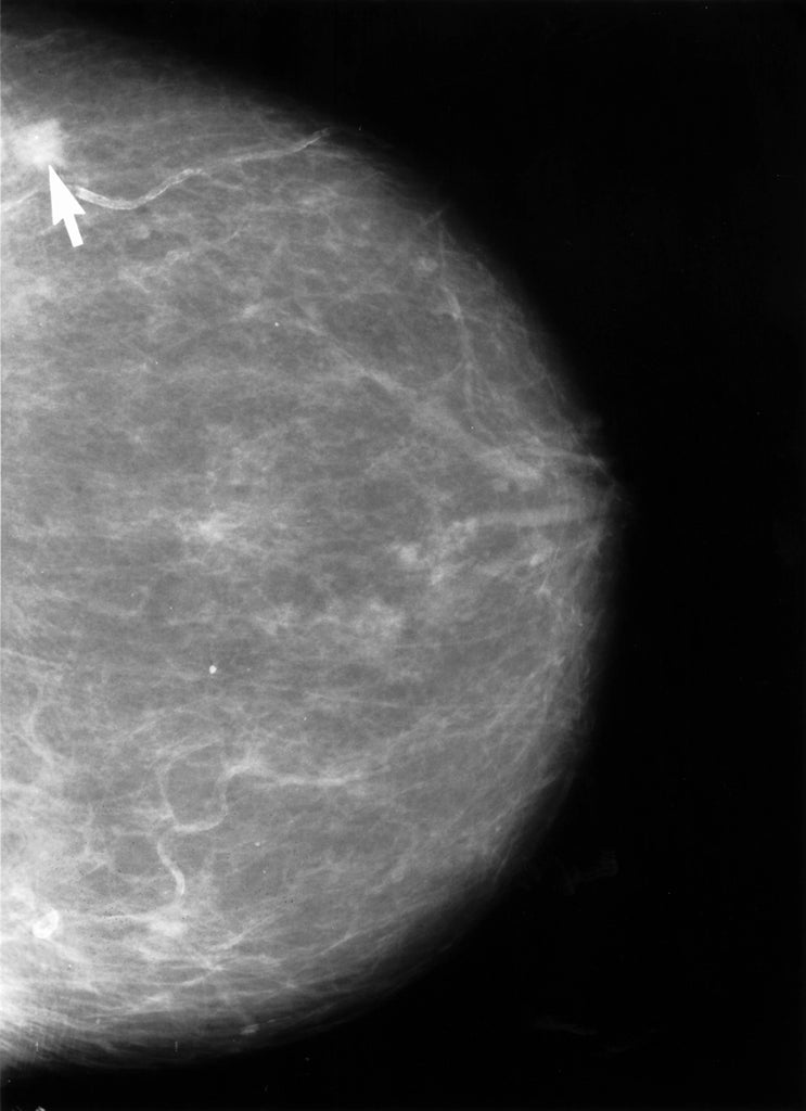 mammogram with calcifications