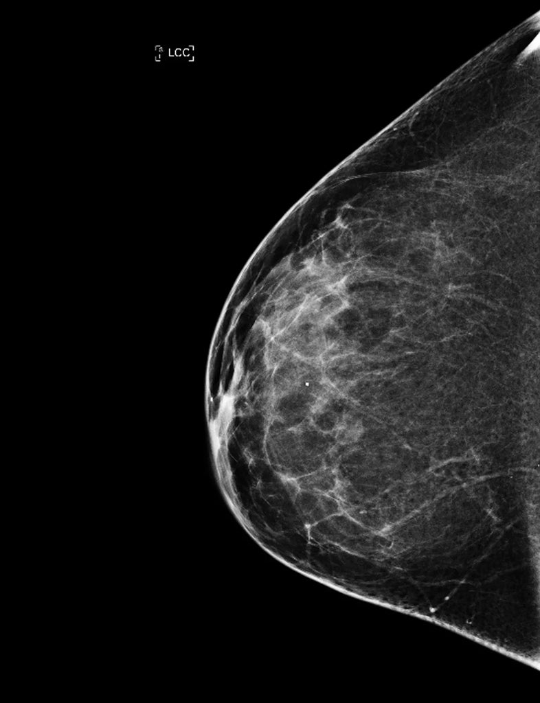 normal breast tomosynthesis
