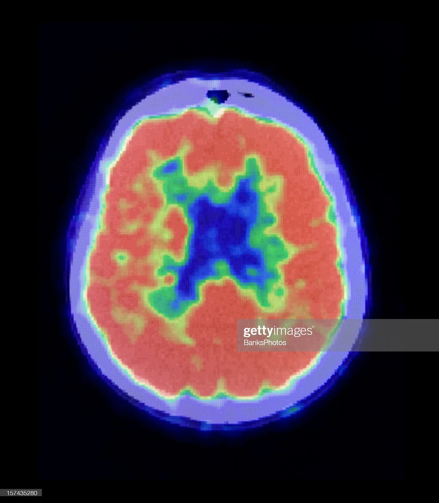 PET scan of human brain