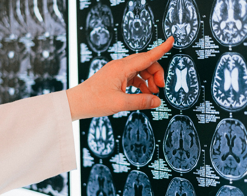 subdural hemorrhages quick guide