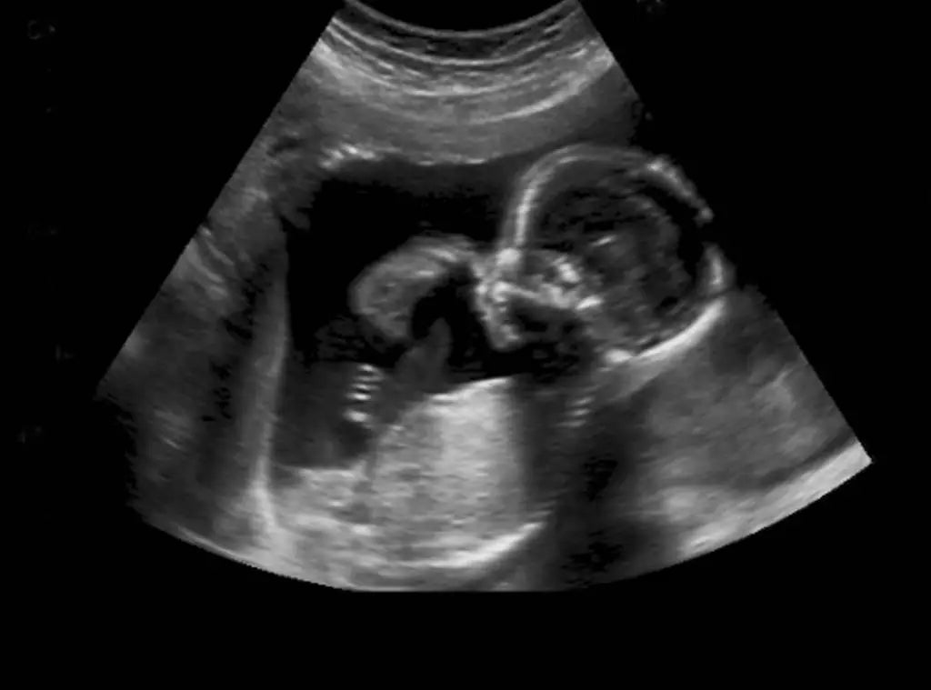 ultrasound of a fetus in its mother's womb