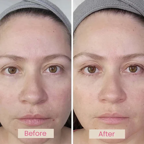 EvenSkyn Mirage Pro LED Phototherapy Face Mask Before And After