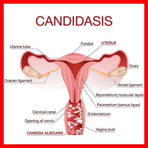 Vaginal Yeast Infection Candidiasis