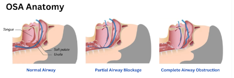 Diagram of Obstructive Sleep Apnea