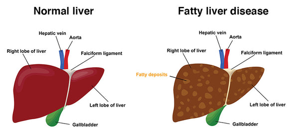 Belly Fat and Fatty Liver 