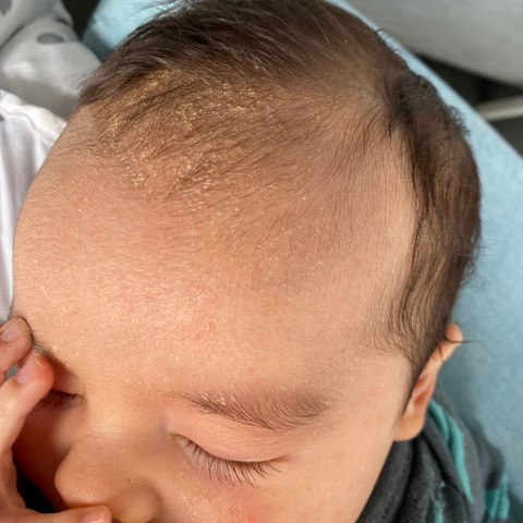 baby with cradle cap