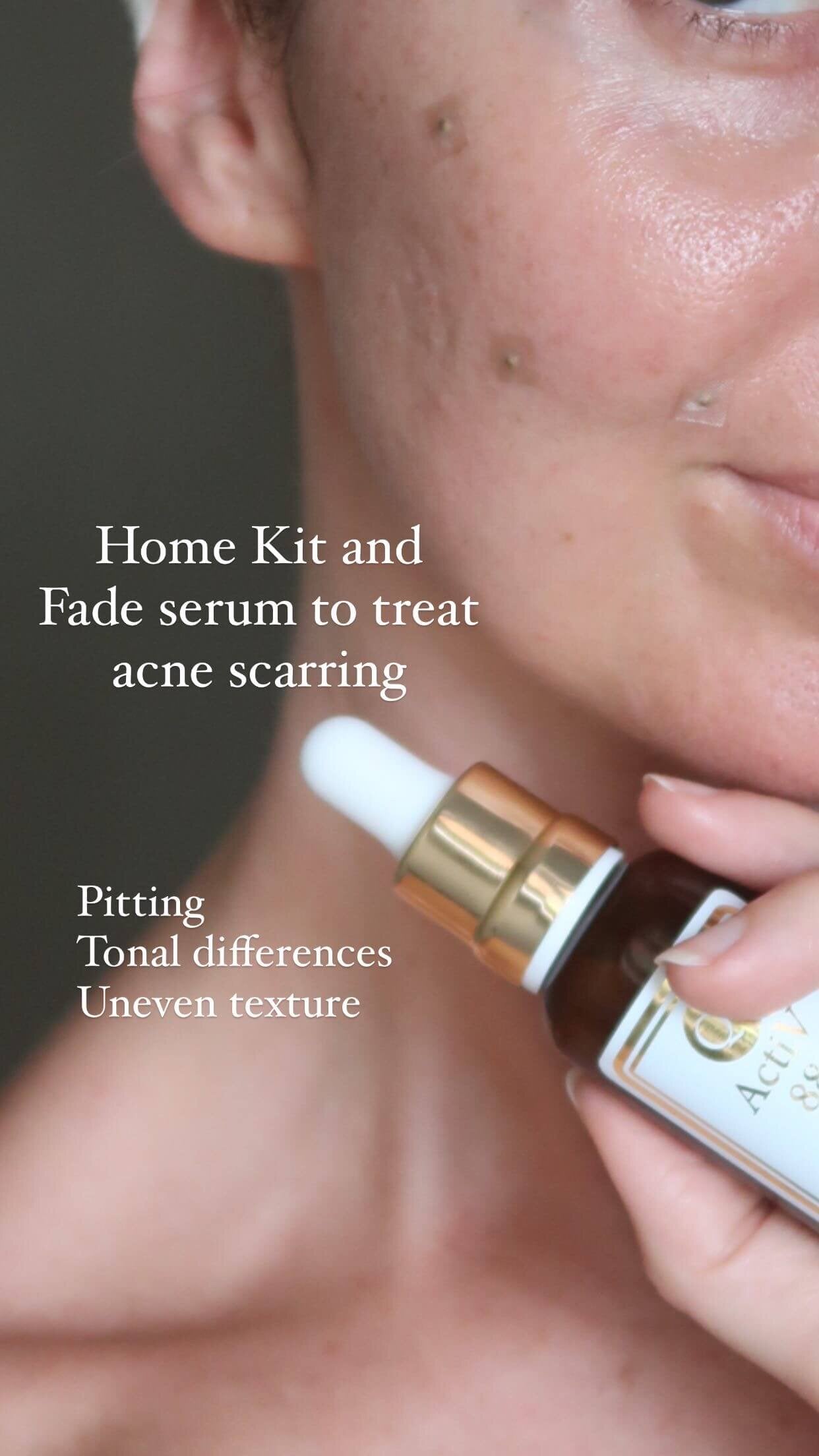 A customised Matrix to address acne scarring and skin pitting with fade serum applied directly over the top.