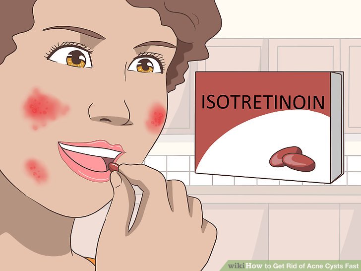 Bước 5: Dùng thuốc retinoid (đường uống) đối với mụn trứng cá dạng bọc