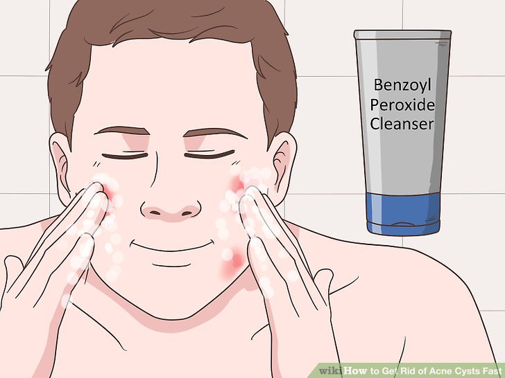 Bước 1: Rửa mặt hai lần một ngày với sữa rửa mặt chứa benzoyl peroxide