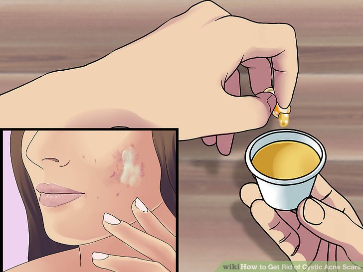 Bước 4: Xoa nhẹ vitamin vào các vết sẹo