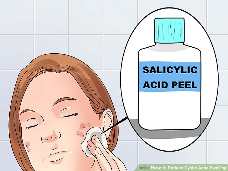 Bước 4: Chấm axit salicylic hoặc azelaic để chống lại vi khuẩn và làm sạch nang lông