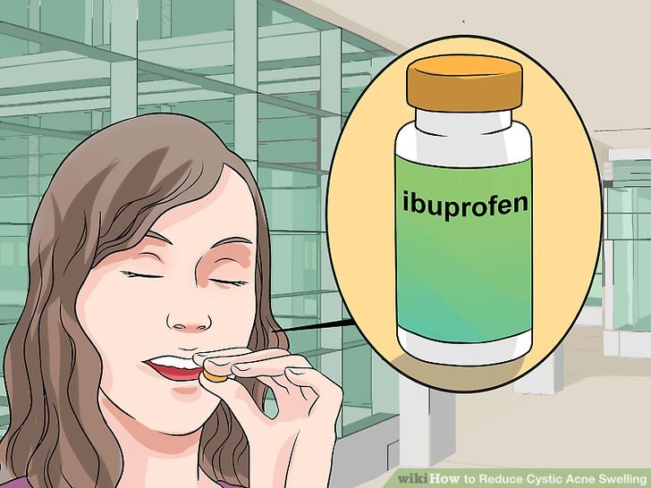 Bước 2: Uống thuốc ibuprofen hoặc một loại thuốc chống viêm không steroid (NSAID) khác