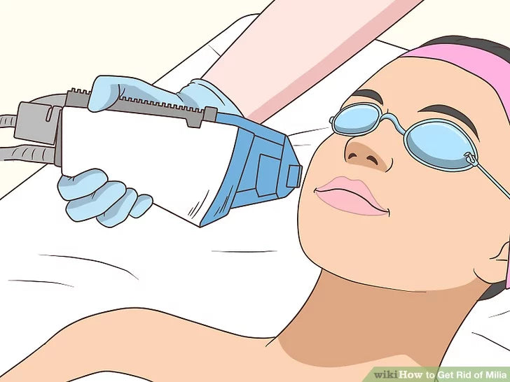 Bước 3: Tiến hành trích xuất da mặt hoặc cắt laser để làm sạch sâu.