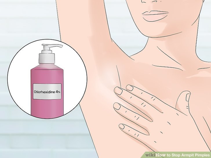 Bước 2: Thử rửa với chất khử trùng để làm sạch da nếu xà phòng thông thường không có tác dụng