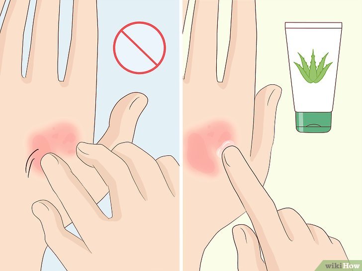 Bước 3: Sau khi trị liệu bằng laser, da của bạn cần được chăm sóc kỹ lưỡng trong 2 tuần.