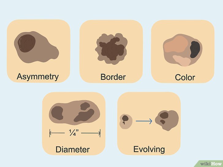 Bước 4: Nốt ruồi ác tính (ung thư da) là một loại ung thư phát sinh từ các tế bào hắc tố trong da hoặc các niêm mạc khác.