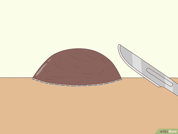Bước 1: Phương pháp cắt bỏ nốt ruồi trên mặt là một trong những cách hiệu quả để loại bỏ những nốt ruồi không mong muốn.