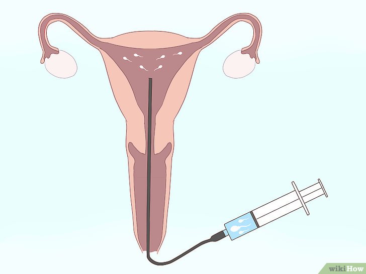 Bước 5: Phương pháp thụ tinh nhân tạo (IUI) là một kỹ thuật sinh sản hỗ trợ giúp tăng khả năng thụ thai cho các cặp vợ chồng gặp khó khăn trong việc có con.