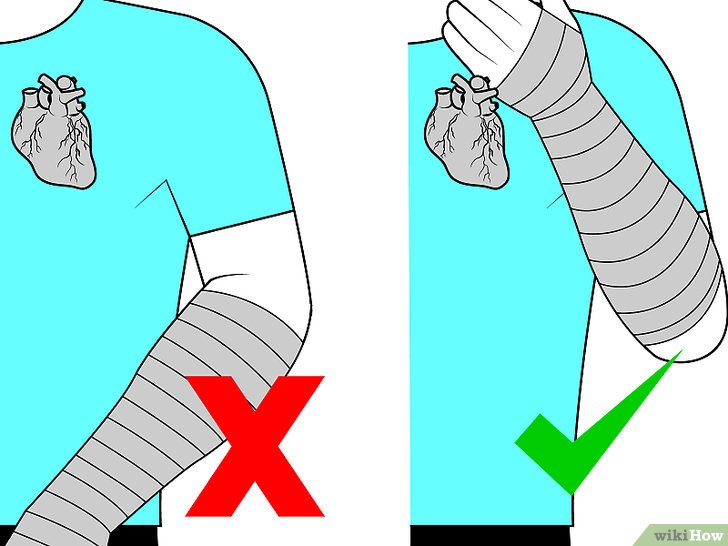 Bước 6: Khi bạn bị chấn thương cổ tay, một trong những biện pháp đầu tiên bạn nên làm là kê cao cổ tay.