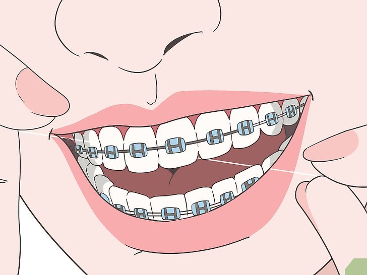 Bước 1: Chải răng bằng chỉ nha khoa là một phương pháp hiệu quả để giữ cho răng và nướu khỏe mạnh, đặc biệt là khi bạn đang đeo niềng răng.