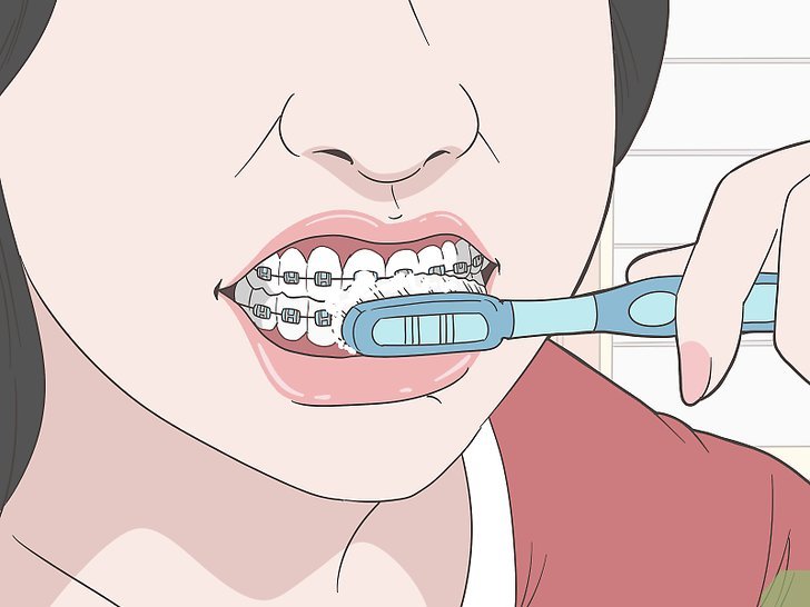 Bước 2: Để bảo vệ răng miệng khi đang đeo niềng răng, bạn nên đánh răng sau mỗi bữa ăn.