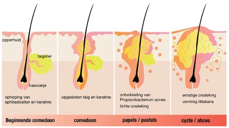 hoe ontstaat acne