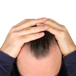 hairline is receding - how to know if your hairline is receding