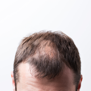 Patchy Bald Spots on Head. 