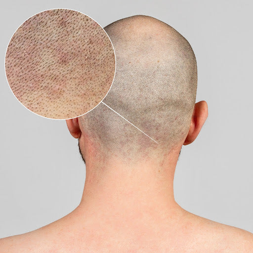 shaving rash on head